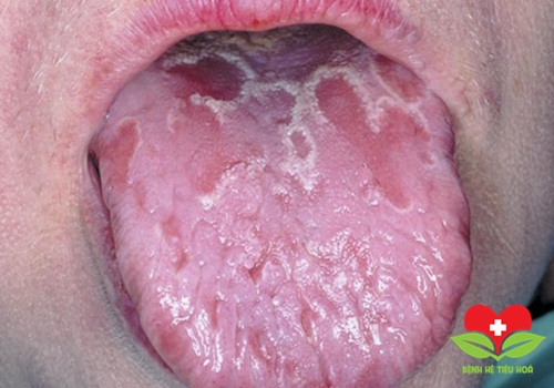 Định nghĩa về bệnh lưỡi bản đồ là gì? Định nghĩa về bệnh lưỡi bản đồ là gì?