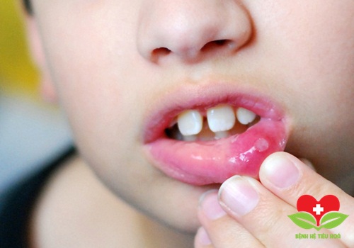 Nguyên nhân gây viêm loét miệng áp-tơ Nguyên nhân gây viêm loét miệng áp-tơ