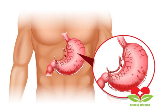 Bệnh nhân xuất huyết có biểu hiện đau bụng nhiều Bệnh nhân xuất huyết có biểu hiện đau bụng nhiều