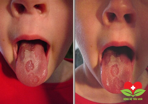 Dấu hiệu nhận biết bệnh lưỡi bản đồ lành tính ở trẻ em Dấu hiệu nhận biết bệnh lưỡi bản đồ lành tính ở trẻ em