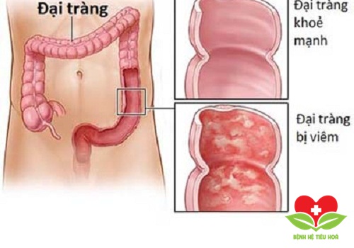 Định nghĩa cơ bản về bệnh viêm loét đại tràng? Định nghĩa cơ bản về bệnh viêm loét đại tràng?