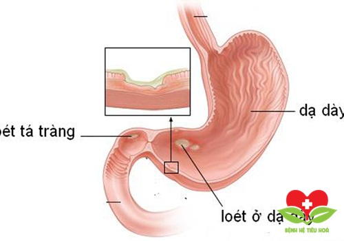 6 nguyên nhân chính khiến bạn có nguy cơ bị viêm loét dạ dày tá tràng 6 nguyên nhân chính khiến bạn có nguy cơ bị viêm loét dạ dày tá tràng