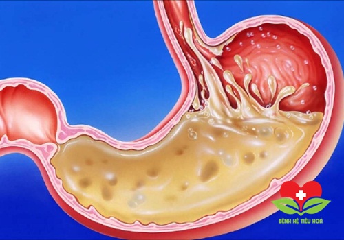 Dấu hiệu điển hình của chứng trào ngược dạ dày không phải ai cũng biết Dấu hiệu điển hình của chứng trào ngược dạ dày không phải ai cũng biết