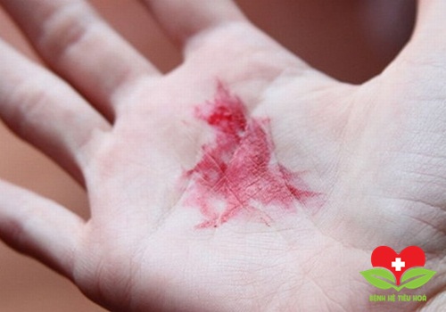 Triệu chứng chứng tỏ bạn đã bị xuất huyết dạ dày nguy hiểm Triệu chứng chứng tỏ bạn đã bị xuất huyết dạ dày nguy hiểm