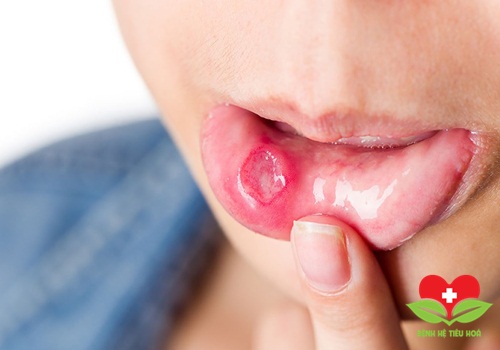 Biểu hiện thường gặp của các dạng viêm loét miệng hiện nay Biểu hiện thường gặp của các dạng viêm loét miệng hiện nay