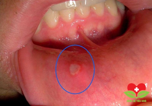 Viêm loét miệng là triệu chứng cảnh báo nhiều bệnh nguy hiểm chết người Viêm loét miệng là triệu chứng cảnh báo nhiều bệnh nguy hiểm chết người