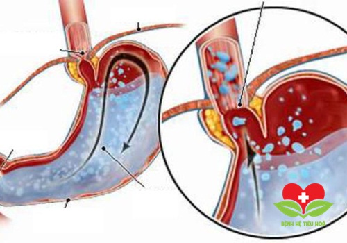 Trào ngược dạ dày là một nguyên nhân rất thường gặp trong bệnh viêm thực quản Trào ngược dạ dày là một nguyên nhân rất thường gặp trong bệnh viêm thực quản