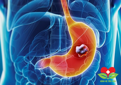 Nguy cơ mắc ung thư dạ dày tăng cao do sử dụng thuốc ức chế bơm Proton Nguy cơ mắc ung thư dạ dày tăng cao do sử dụng thuốc ức chế bơm Proton