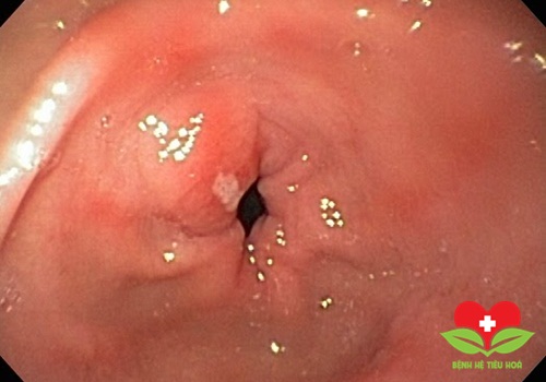 Những điều cần biết về bệnh viêm hang vị dạ dày Những điều cần biết về bệnh viêm hang vị dạ dày