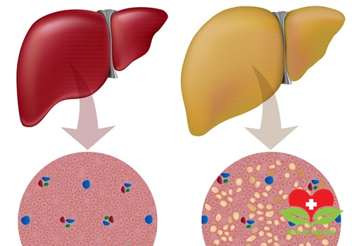 Chuyên gia lý giải lý do khiến người gầy vẫn bị gan nhiễm mỡ? Chuyên gia lý giải lý do khiến người gầy vẫn bị gan nhiễm mỡ?