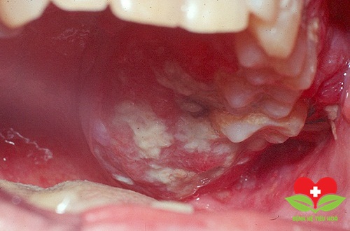 Nhiều bệnh nhân phát hiện bị ung thư miệng ở giai đoạn muộn Nhiều bệnh nhân phát hiện bị ung thư miệng ở giai đoạn muộn