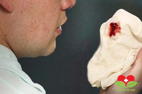 Ói ra máu là dấu hiệu bệnh xuất huyết dạ dày Ói ra máu là dấu hiệu bệnh xuất huyết dạ dày