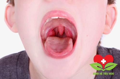 Khuyến cáo: Dễ nhầm bệnh viêm loét miệng với bệnh ung thư miệng Khuyến cáo: Dễ nhầm bệnh viêm loét miệng với bệnh ung thư miệng