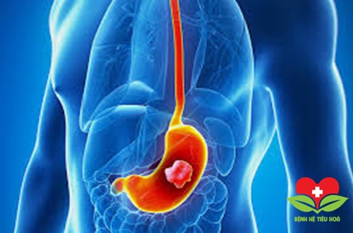 Nhiều người bị ung thư dạ dày chỉ vì …nghiện ăn đồ nướng Nhiều người bị ung thư dạ dày chỉ vì …nghiện ăn đồ nướng