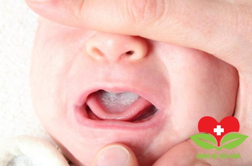 Tìm hiểu bệnh lưỡi bản đồ ở trẻ em Tìm hiểu bệnh lưỡi bản đồ ở trẻ em