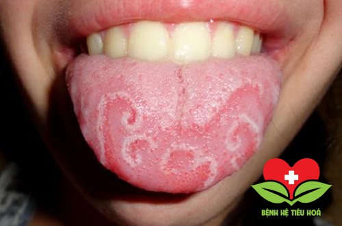 Thương tổn cận lâm sàng bệnh lưỡi bản đồ Thương tổn cận lâm sàng bệnh lưỡi bản đồ