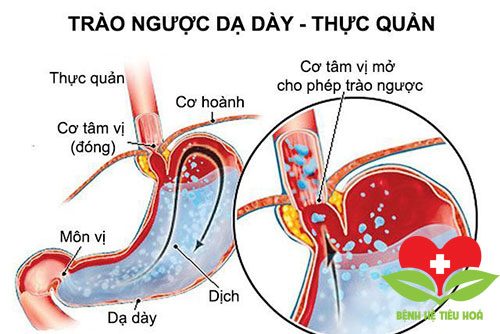 Chuyên gia lý giải những điều cần biết về bệnh viêm ruột thừa