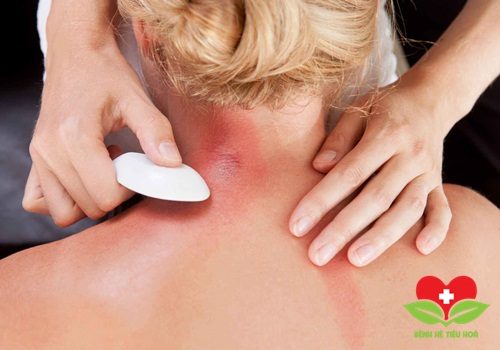 Đánh gió là bài thuốc y học cổ truyền chữa cảm lạnh phổ biến nhất