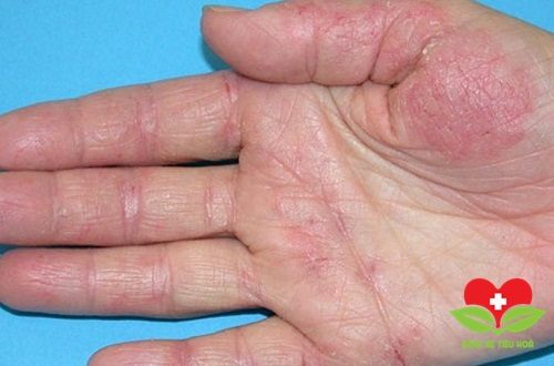 Viêm da cơ địa cũng là bệnh thường gặp trong mùa Đông này