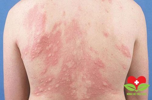 Da bị mày đay do lạnh là bệnh lý phổ biến vào mùa Đông