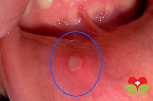 Những điều không thể không biết về chứng lở loét miệng