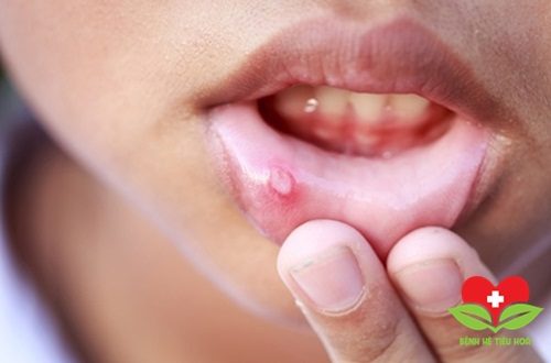 Chuyên gia khuyên người bị loét miệng nên ăn gì nên ăn gì để nhanh khỏi?