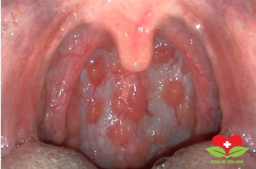 Viêm họng hạt có lây không?