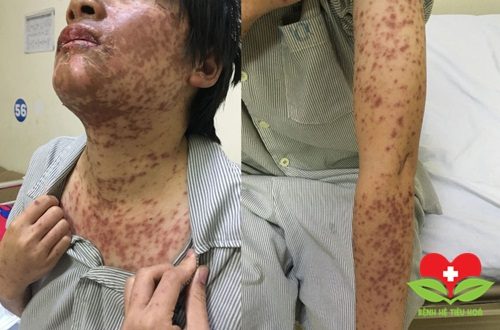 Cảnh báo: Cô gái 27 tuổi nổi mẩn đỏ vì uống thuốc chữa cảm cúm