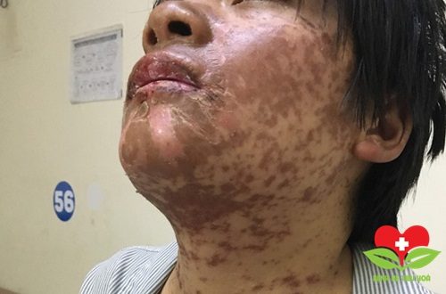 Cô gái bị dị ứng với thuốc chữa cảm cúm nhập viện vì bị mẩn đỏ khắp người