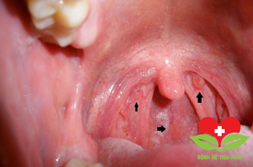 Thời gian ủ bệnh (phát triển) của ung thư vòm họ Thời gian ủ bệnh (phát triển) của ung thư vòm họ