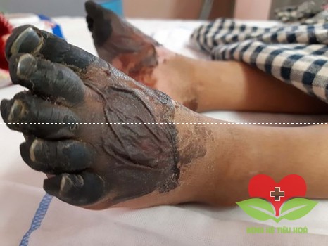 Cẩn thận: Cắt bỏ tứ chi chỉ vì một vết xước nhỏ trên da