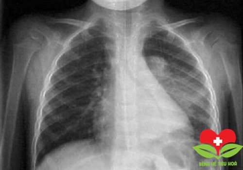 Những nguyên tắc cần nhớ khi điều trị người bị bệnh tràn dịch màng phổi Những nguyên tắc cần nhớ khi điều trị người bị bệnh tràn dịch màng phổi