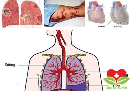 Lý giải: Tràn dịch màng phổi là bệnh gì? Lý giải: Tràn dịch màng phổi là bệnh gì?