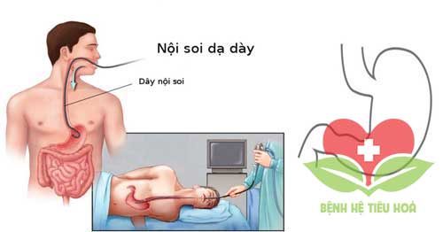 Biện pháp điều trị chứng xuất huyết tiêu hóa Biện pháp điều trị chứng xuất huyết tiêu hóa